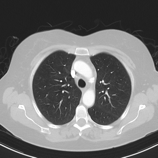 File:Cerebral metastasis mimicking glioblastoma (Radiopaedia 69155-78938 Axial lung window 13).png