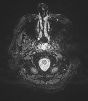 File:Cerebral metastasis to basal ganglia (Radiopaedia 81568-95413 Axial SWI magnitude 3).png