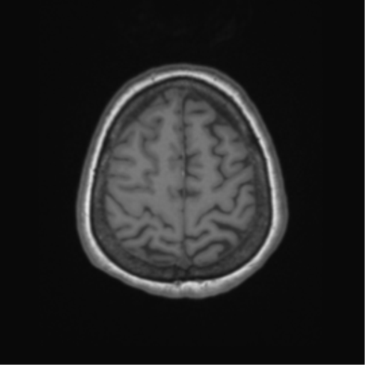 File:Cerebral metastasis to basal ganglia (Radiopaedia 81568-95413 Axial T1 62).png
