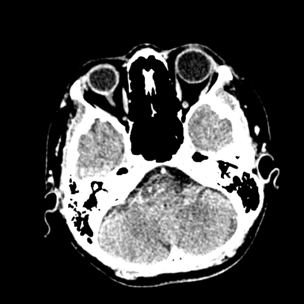 Cerebral ring enhancing lesions - cerebral metastases (Radiopaedia 44922-48818 B 70).jpg