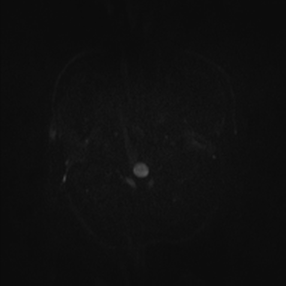 Cerebral toxoplasmosis (Radiopaedia 53993-60132 Axial DWI 28).jpg