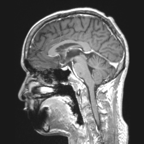 File:Cerebral toxoplasmosis (Radiopaedia 53993-61435 Axial T1 27).jpg