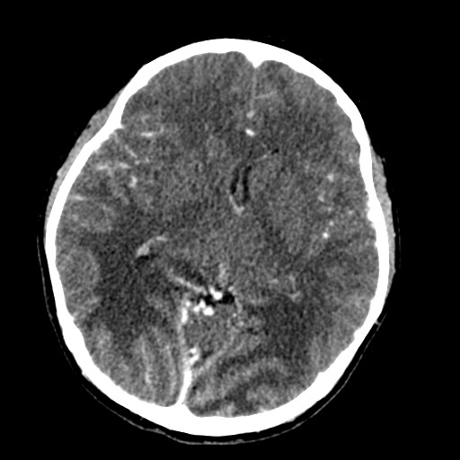 Cerebral tuberculosis with dural sinus invasion (Radiopaedia 60353-68019 Axial C+ delayed 30).jpg