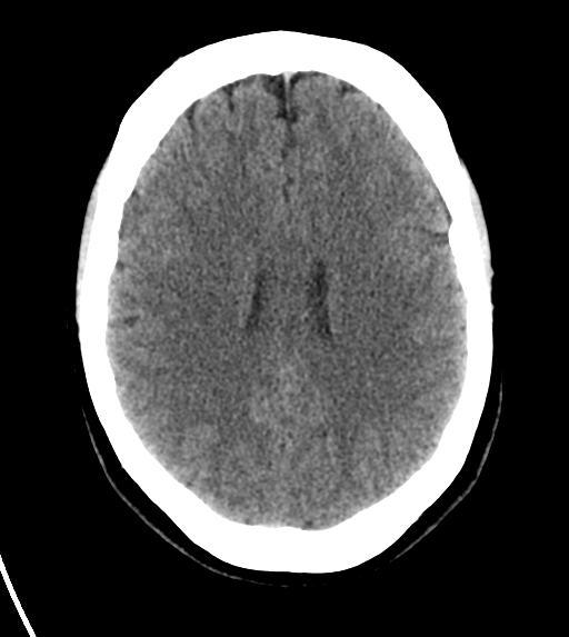 File:Cerebral venous infarct related to dural venous sinus thromboses (Radiopaedia 35292-36804 Axial non-contrast 19).png