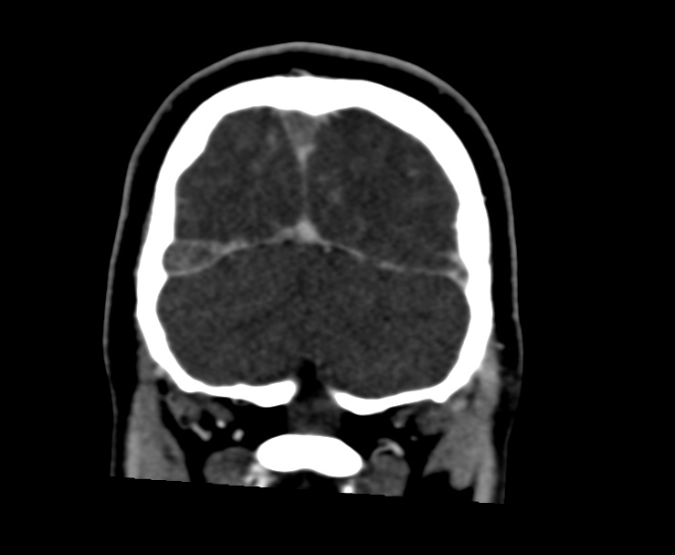Cerebral venous sinus thrombosis (Radiopaedia 59224-66646 Coronal C+ delayed 67).jpg