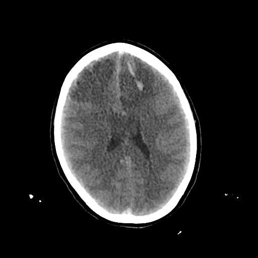 Cerebral venous throbmosis - hemorrhagic venous infarction (Radiopaedia 87318-103613 Axial non-contrast 105).jpg