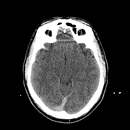 File:Cerebral venous thrombosis (CVT) (Radiopaedia 77524-89685 Axial non-contrast 20).jpg