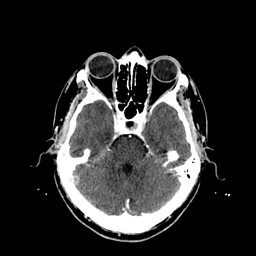 File:Cerebral venous thrombosis (CVT) (Radiopaedia 77524-89685 Axial with contrast 12).jpg