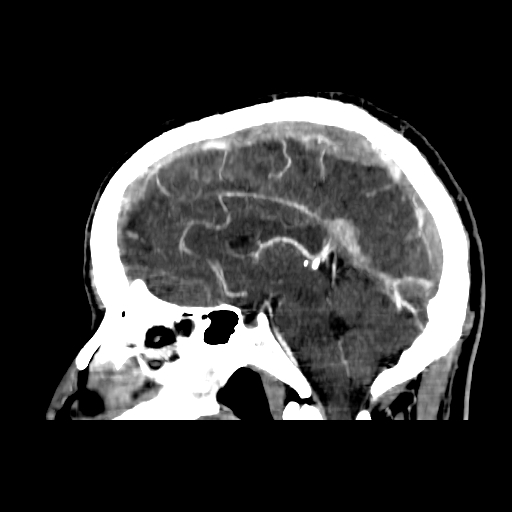 File:Cerebral venous thrombosis (CVT) (Radiopaedia 77524-89685 Sagittal CTV 21).jpg