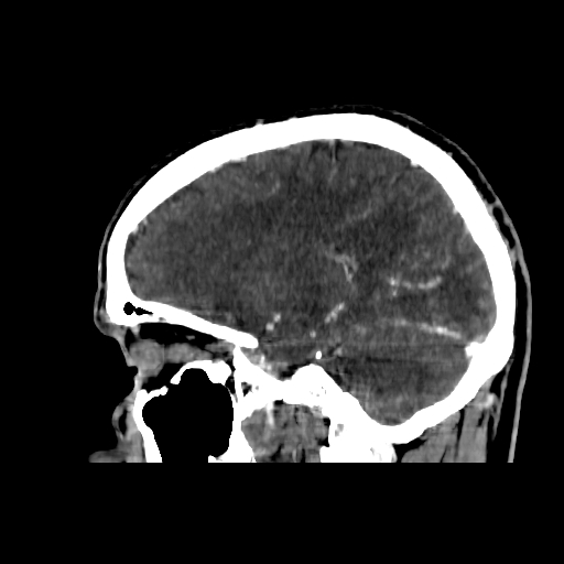 File:Cerebral venous thrombosis (CVT) (Radiopaedia 77524-89685 Sagittal CTV 29).jpg