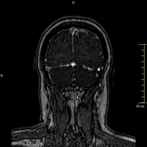 Cerebral venous thrombosis (Radiopaedia 23288-23351 MRV 152).JPG
