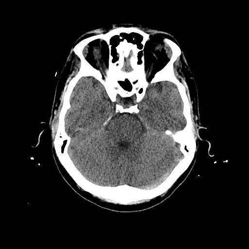 Cerebral venous thrombosis with venous hemorrhagic infarct (Radiopaedia 90354-107660 Axial non-contrast 17).jpg