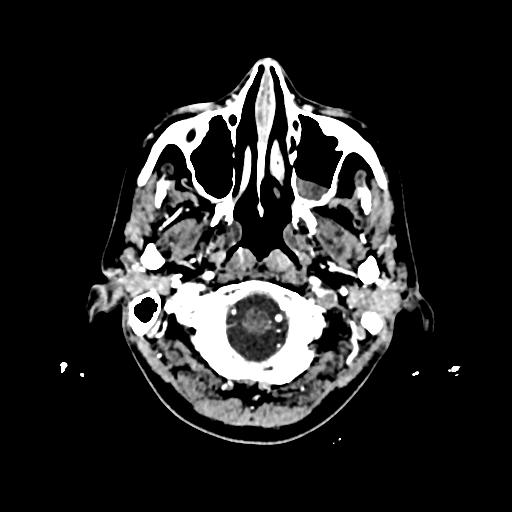 Cerebral venous thrombosis with venous hemorrhagic infarct (Radiopaedia 90354-107660 Axial with contrast 16).jpg