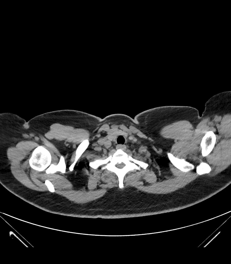 Cervical aortic arch with coarctation and aneurysms (Radiopaedia 44035-47552 Axial non-contrast 7).jpg