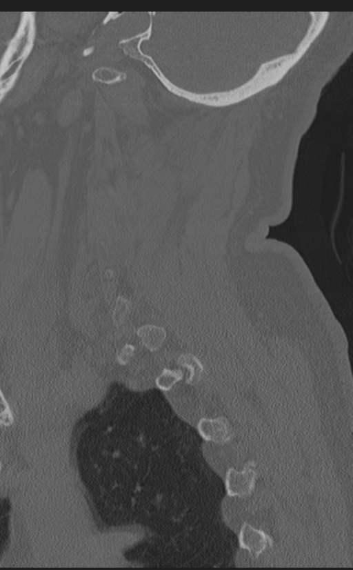 Cervical canal stenosis due to ossification of the posterior longitudinal ligament (Radiopaedia 47260-51823 Sagittal bone window 61).png