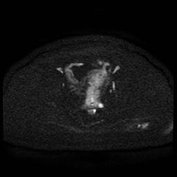 Cervical carcinoma (Radiopaedia 85405-101028 Axial DWI 70).jpg