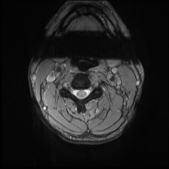 File:Cervical disc extrusion (Radiopaedia 53950-60077 Axial T2 10).jpg