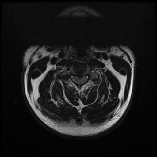 File:Cervical disc extrusion (Radiopaedia 59074-66364 Axial T2 3).jpg