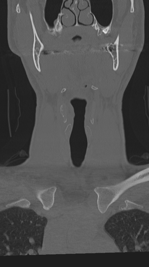 Cervical intercalary bone (Radiopaedia 35211-36748 Coronal bone window 9).png