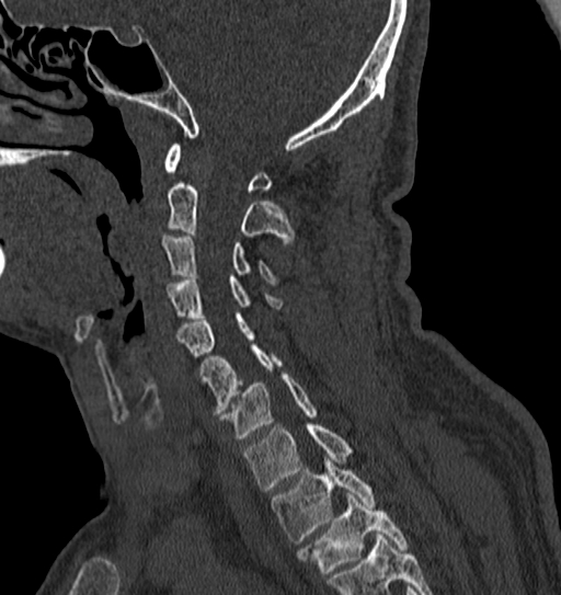 Cervical spine trauma with tear drop fracture and perched facet joint (Radiopaedia 53989-60127 Sagittal bone window 100).jpg