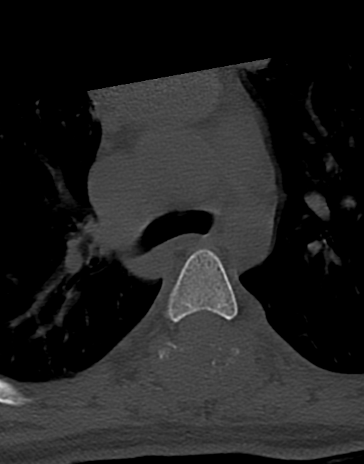 Cervical tuberculous spondylitis (Radiopaedia 39149-41365 Axial bone window 65).png