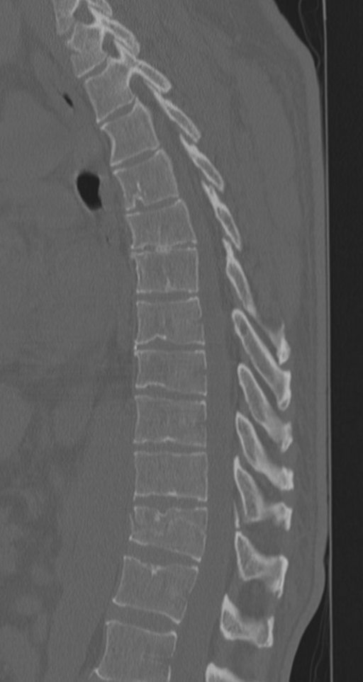Chance fracture (Radiopaedia 33854-35020 Sagittal bone window 41).png