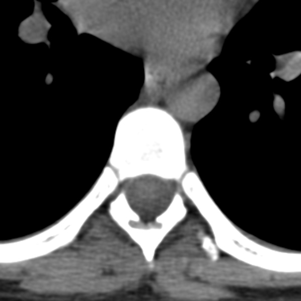 File:Chance fracture (Radiopaedia 36521-38081 Axial non-contrast 4).jpg