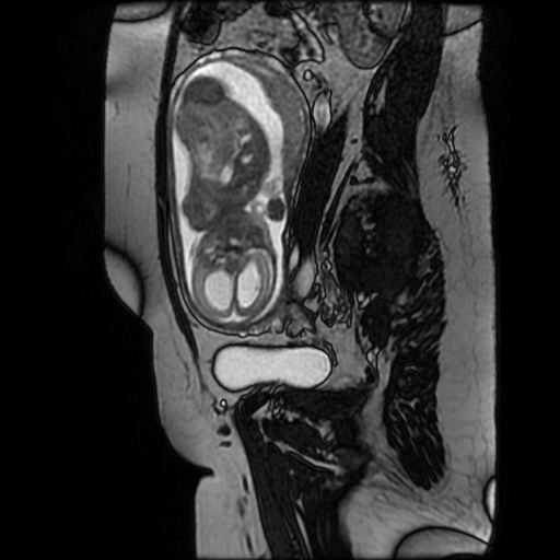 Chiari II malformation - fetal MRI (Radiopaedia 68099-77581 Sagittal Fiesta 18).jpg