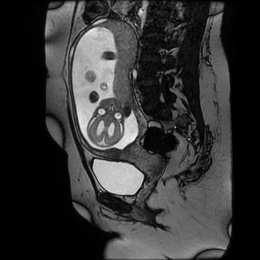 Chiari II malformation - fetal MRI (Radiopaedia 68099-77581 Sagittal Fiesta 26).jpg