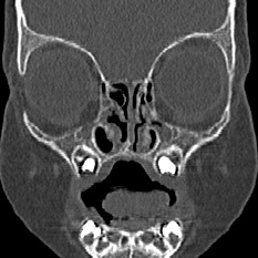 Choanal atresia (Radiopaedia 88525-105975 Coronal bone window 24).jpg