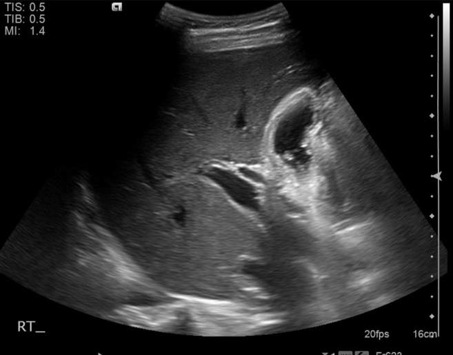File:Cholecystitis - perforated gallbladder (Radiopaedia 57038-63913 A 31).jpg