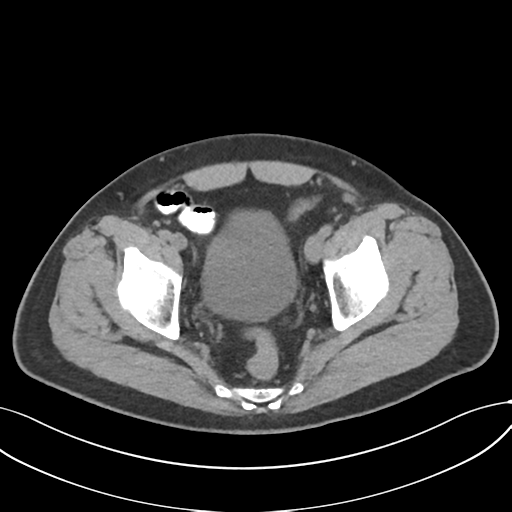 Cholecystitis with focal perforation and hepatic abscess (Radiopaedia 37189-38945 Axial non-contrast 76).png