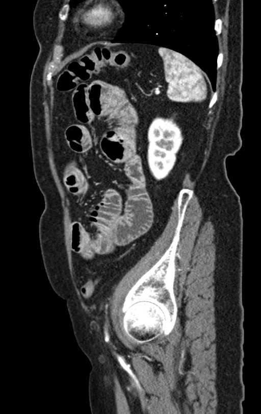 Cholecystoduodenal fistula due to calculous cholecystitis with gallstone migration (Radiopaedia 86875-103077 C 14).jpg