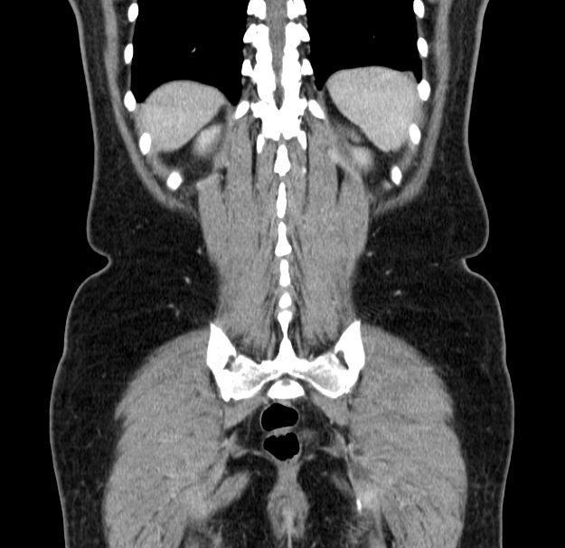 Choledocholithiasis on CT and MRI (Radiopaedia 24825-25087 C 44).jpg