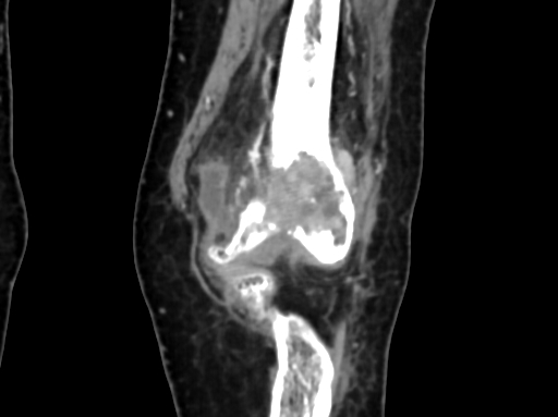 Chondrosarcoma - femur (Radiopaedia 64187-72954 C 18).jpg