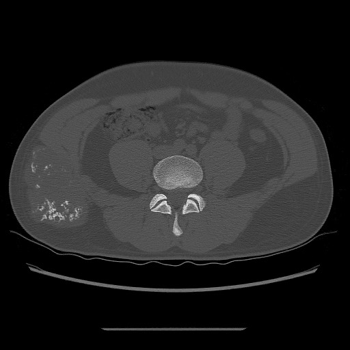 File:Chondrosarcoma of iliac wing (Radiopaedia 63861-72599 Axial bone window 31).jpg