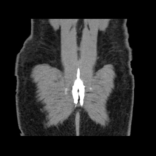 File:Chondrosarcoma of iliac wing (Radiopaedia 63861-72599 Coronal non-contrast 104).jpg