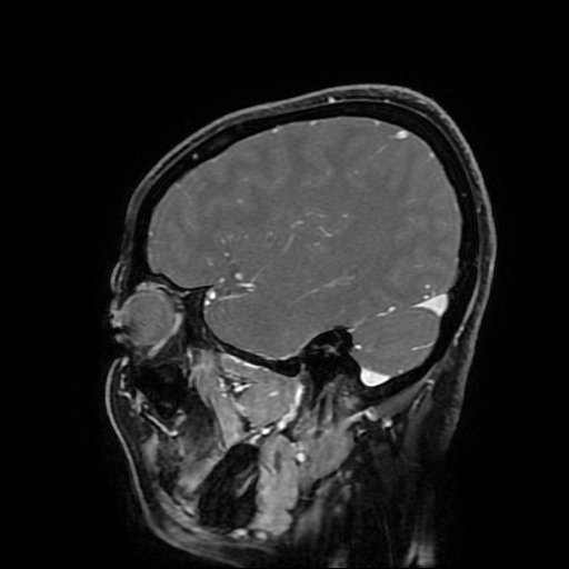 File:Chordoid glioma of third ventricle (Radiopaedia 91612-109340 F 59).jpg