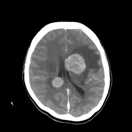 File:Choriocarcinoma of ovary with cerebral and pulmonary metastases (Radiopaedia 25983-26118 A 15).jpg