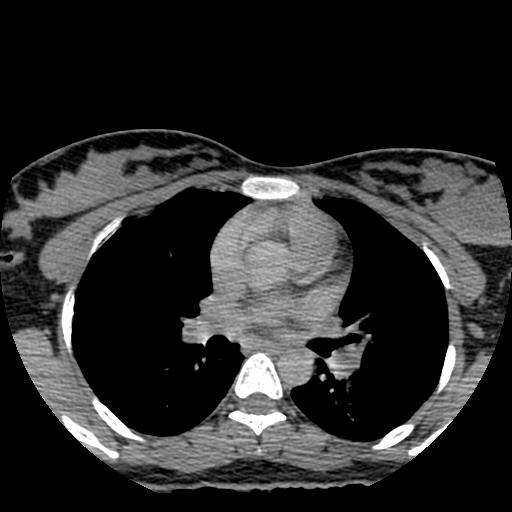 File:Choriocarcinoma of ovary with cerebral and pulmonary metastases (Radiopaedia 25983-26119 Axial non-contrast 134).jpg