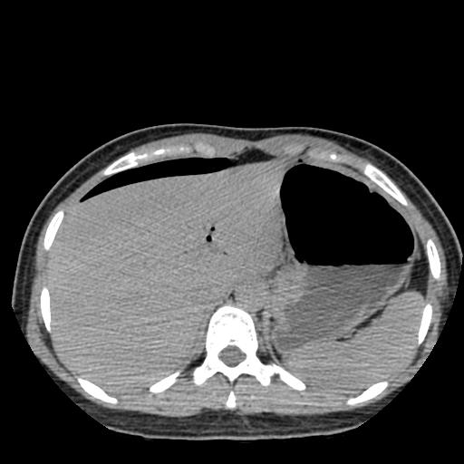 File:Choriocarcinoma of ovary with cerebral and pulmonary metastases (Radiopaedia 25983-26119 Axial non-contrast 59).jpg