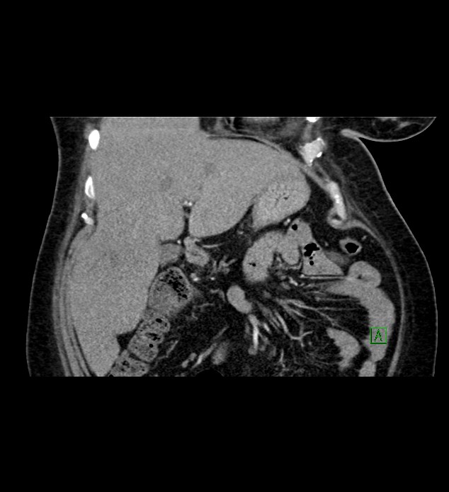 Chromophobe renal cell carcinoma (Radiopaedia 84239-99519 C 31).jpg