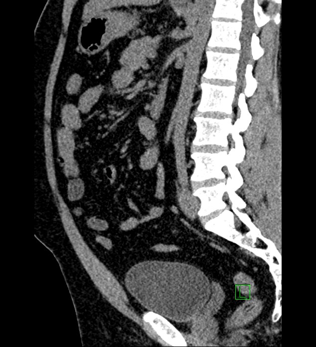 Chromophobe renal cell carcinoma (Radiopaedia 84286-99573 C 82).jpg