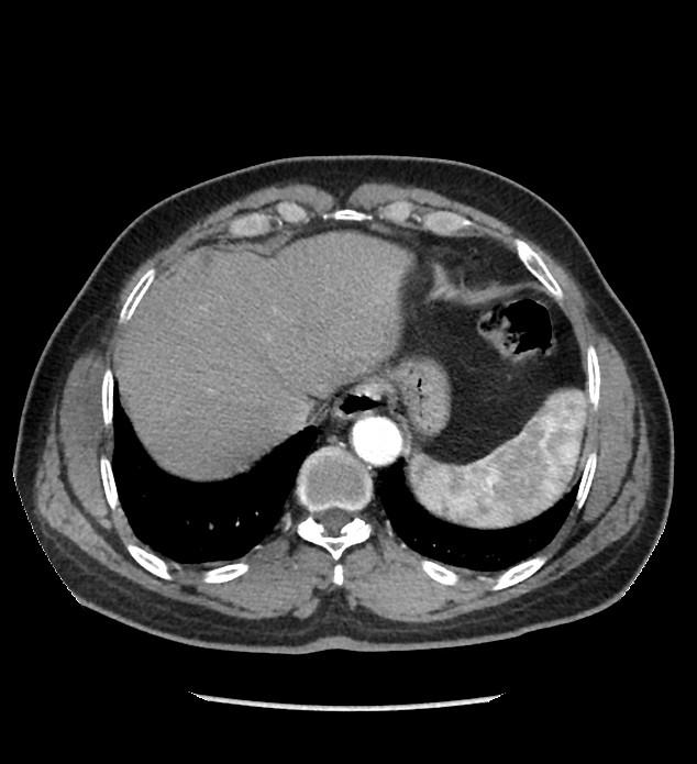 Chromophobe renal cell carcinoma (Radiopaedia 86879-103083 B 22).jpg