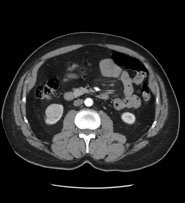 Chromophobe renal cell carcinoma (Radiopaedia 86879-103083 B 69).jpg
