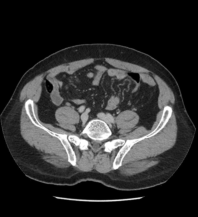 Chromophobe renal cell carcinoma (Radiopaedia 86879-103083 C 107).jpg