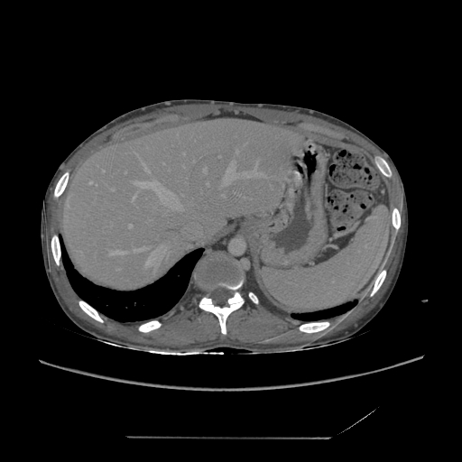 File:Chronic IVC thrombosis and resultant IVC filter malposition (Radiopaedia 81158-94800 A 13).jpg