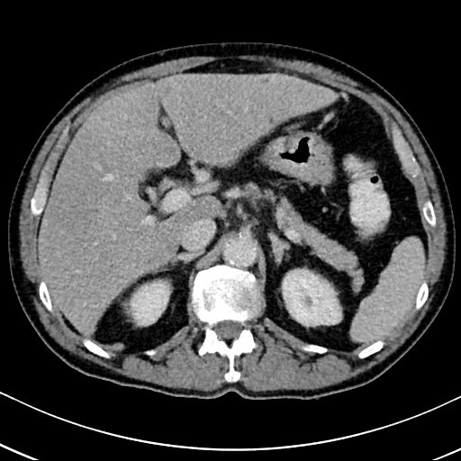 Chronic appendicitis complicated by appendicular abscess, pylephlebitis and liver abscess (Radiopaedia 54483-60700 B 49).jpg