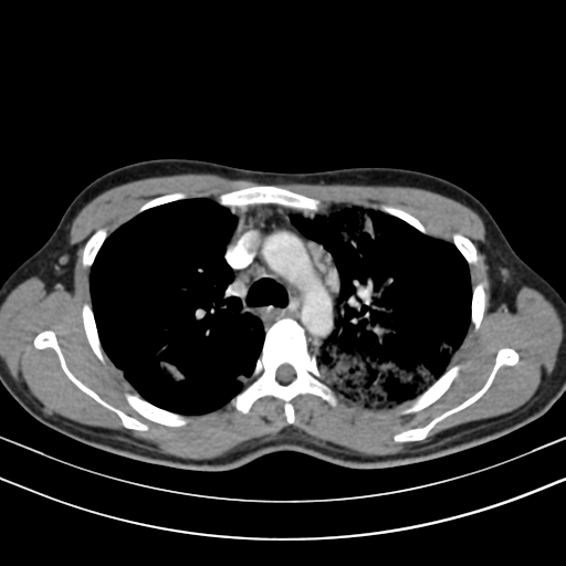 Chronic eosinophilic pneumonia (Radiopaedia 39331-41587 Axial C+ delayed 42).png
