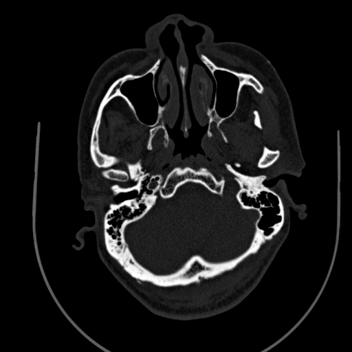 File:Chronic invasive fungal sinusitis (Radiopaedia 91563-109286 Axial sinus 18).jpg